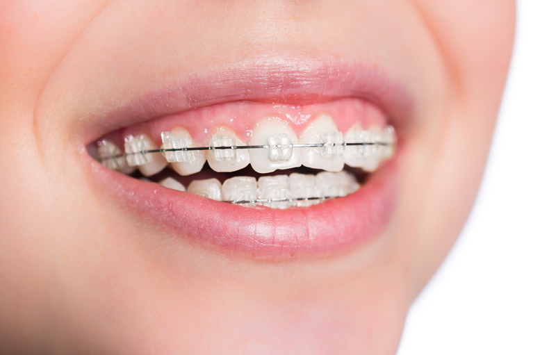 歯列矯正後の後戻り対策〜効果的な予防法を解説